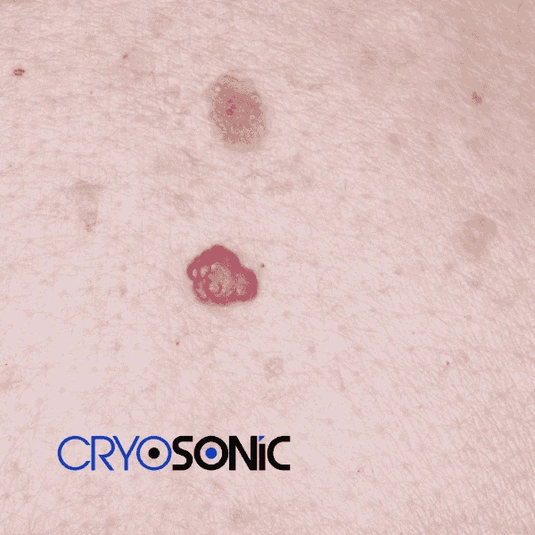 Looking for pain free cherry angioma removal treatment Windsor? Call our team today! Windsor