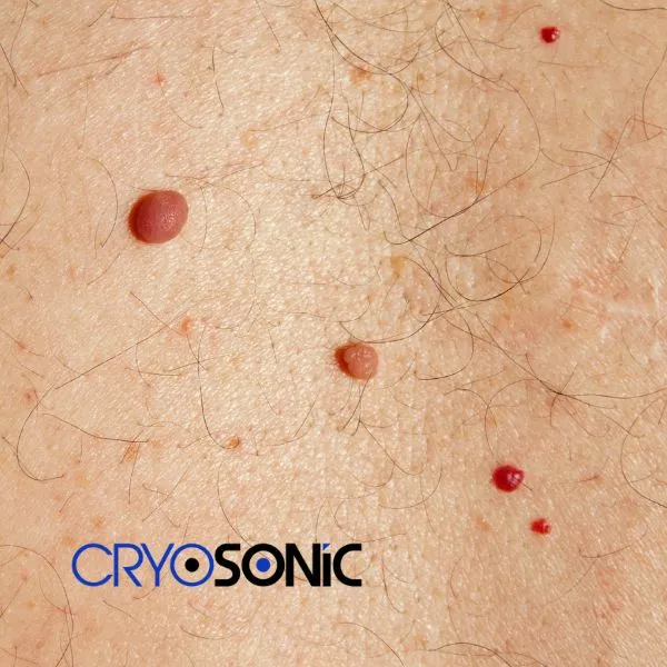 get cherry angioma removal treatment today! Windsor