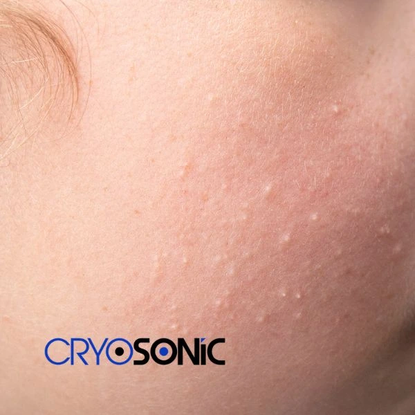 Are you looking for milia removal treatment? Contact our team today Windsor