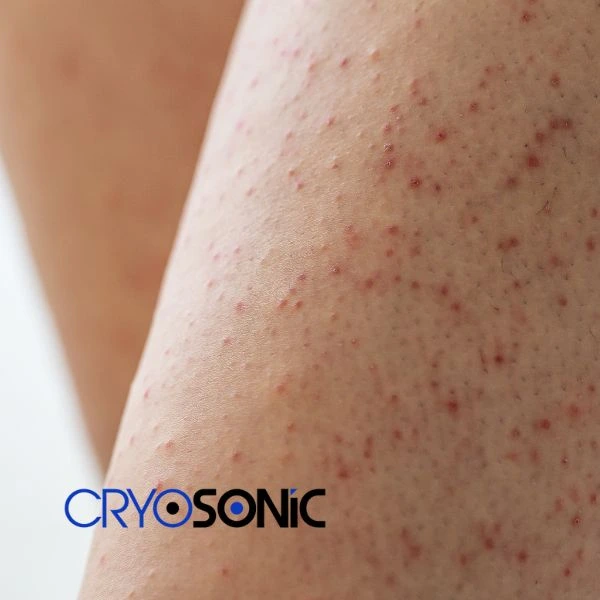Looking for Seborrhoeic Keratosis removal Windsor treatment? Call our consultants today in Windsor