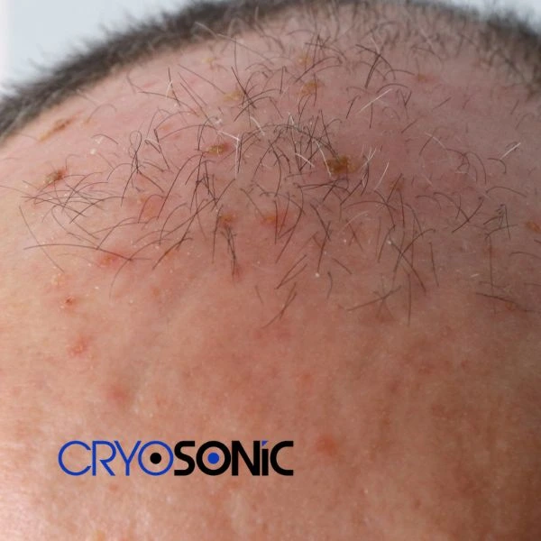 Access Seborrhoeic Keratosis removal from the comfort of your own home! Call us today in Windsor