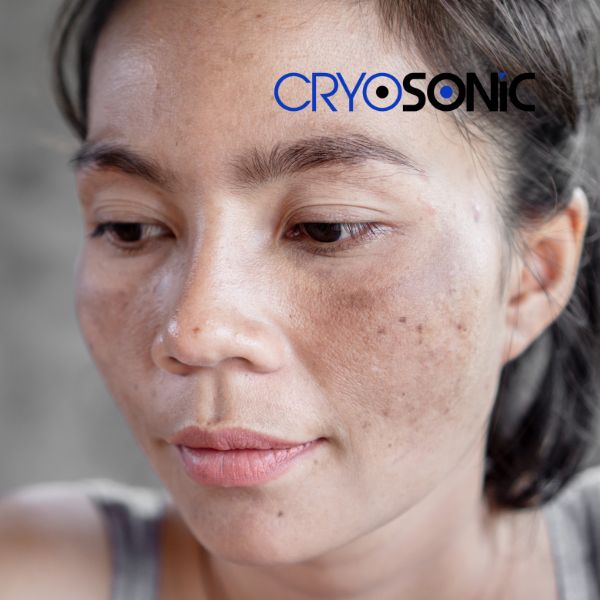 Ready to start age spots removal? Contact our team today in Windsor