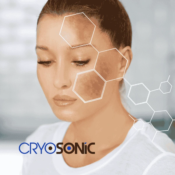 Are you looking for age spot removal treatment? Contact Cryosonic today in Windsor