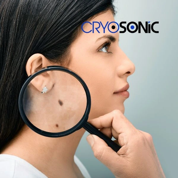 Do you want to learn more about benign moles removal treatment? Call our team today Windsor