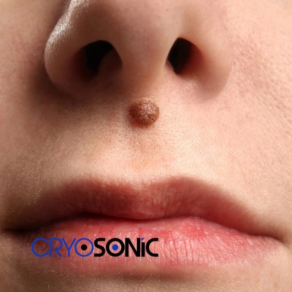 Start your benign moles removal treatment today Windsor