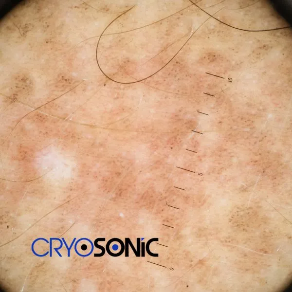 Speak to our team today about sun damaged skin treatment today in Windsor