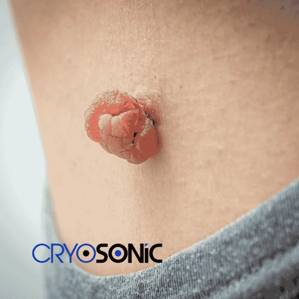 Book your skin tags removal Windsor from comfort of your own home! Windsor