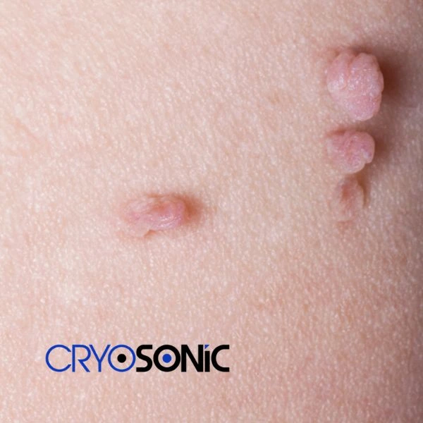 Are you looking for fast effect skin tag removal Windsor? Book in NOW! Windsor
