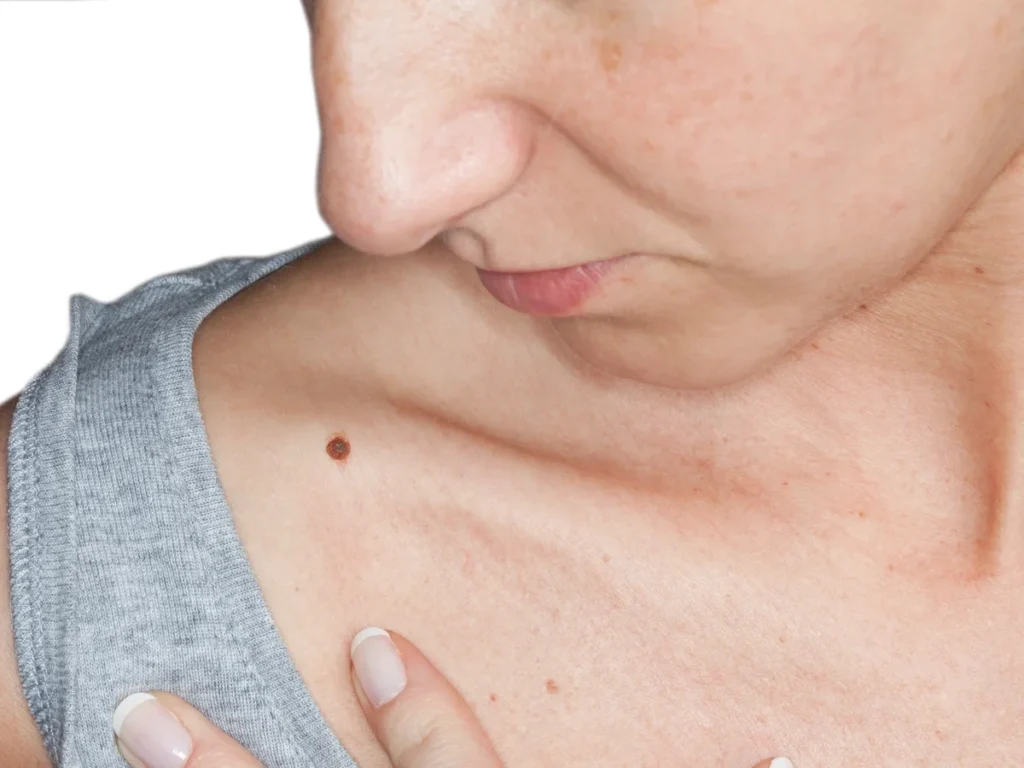 How Does CryoPen Sun Damage Treatment Windsor Work? Windsor