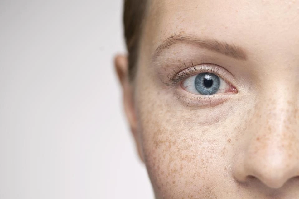 Understanding Sun Damage: How UV Rays Alter Skin and How CryoPen Can Reverse It Windsor