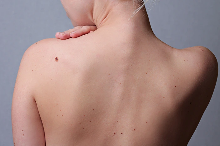 The Skin’s Healing Journey After CryoPen Sun Damage Treatment Windsor