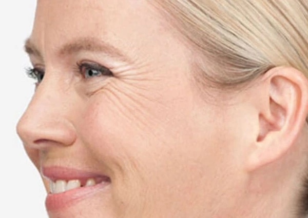 CryoPen Precision vs. Laser: Which Is Better for Sun-Damaged Skin? Windsor