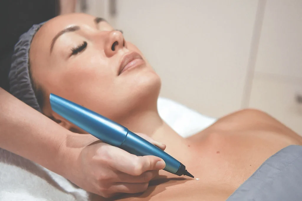 What is CryoPen Technology Windsor? Windsor