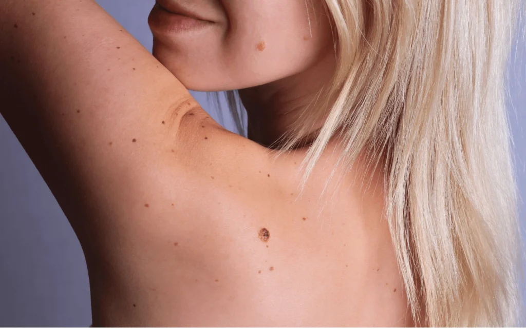What Are Sun Spots and Pigmentation Windsor? Windsor