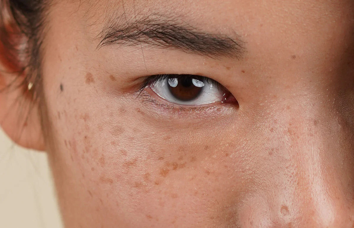 Is There Any Risk of Scarring or Pigmentation Windsor? Windsor