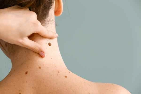 Who Should Avoid CryoPen Treatments? Windsor