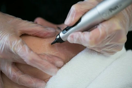 The CryoPen Technology Explained: How Extreme Cold Removes Sun-Damaged Skin Cells Windsor