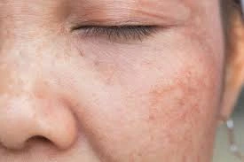 CryoPen Precision vs. Laser: Are Both Treatments Safe? Windsor
