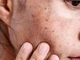 Why CryoPen Works Best for Isolated Sun Spots and Pigmentation Windsor