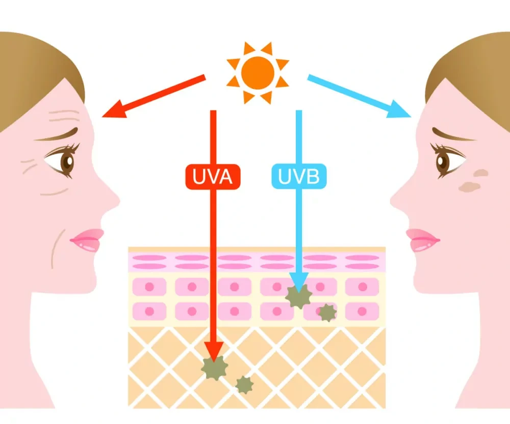 Understanding Sun Damage Windsor - Why Should Sun Damage Be Treated Early? Windsor